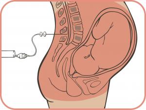 anestesia